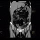 Necrosis of mesenteric fat, postoperative, colectomy: CT - Computed tomography